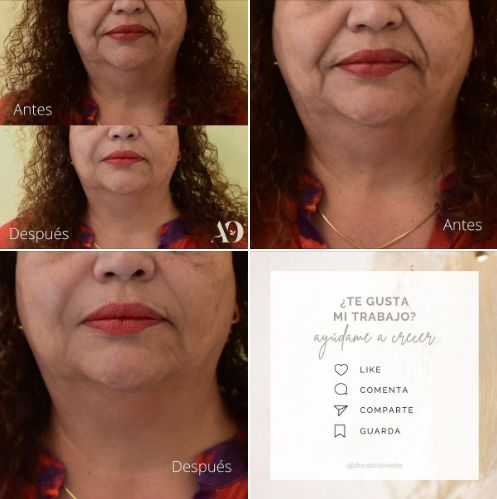 Resultados antes y después de tratamiento de estética facial